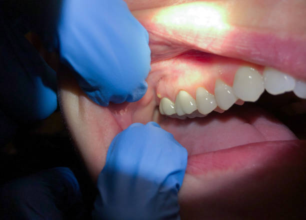 Best Emergency Wisdom Tooth Extraction in Pelican Bay, TX