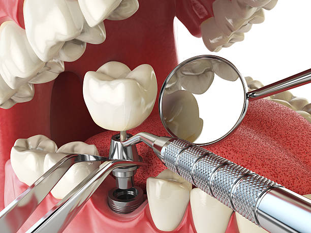 Best Emergency Denture Repair in Pelican Bay, TX